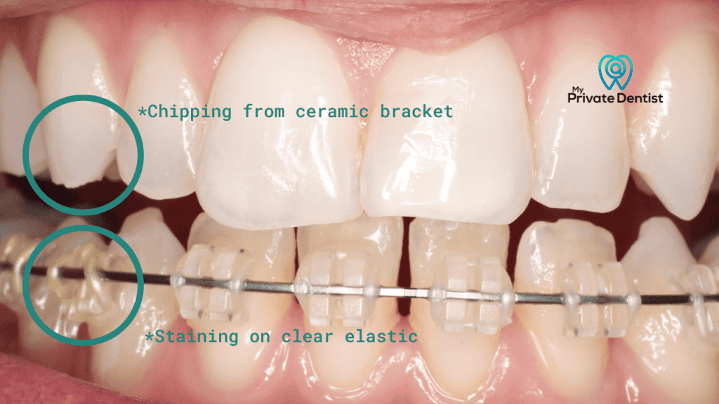 Ceramic Braces