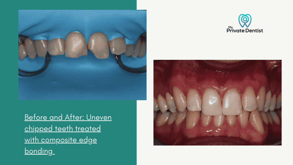 Composite Edge bonding