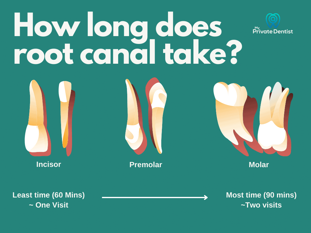 How long does a root canal take?