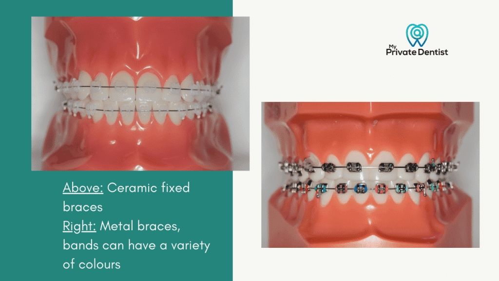 Ceramic Braces