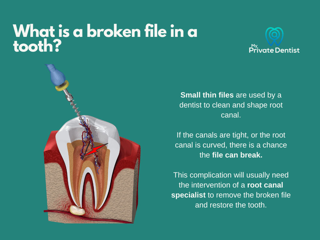 Broken file needs to be removed by root canal specialist
