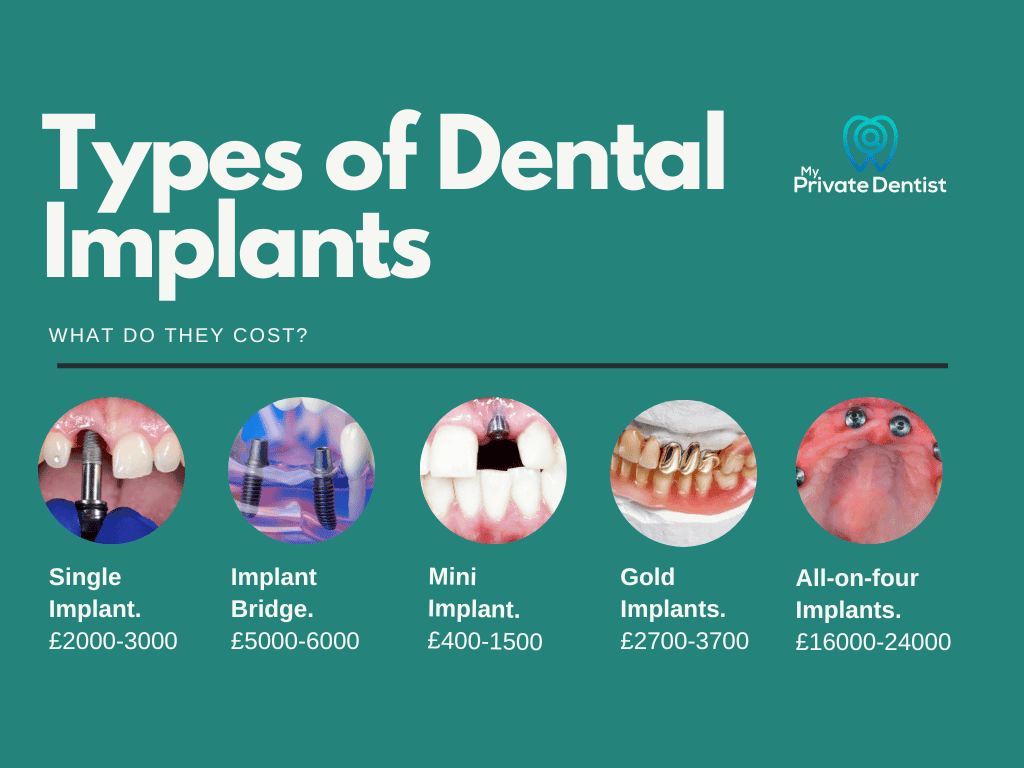 Tooth replacement: Dental Implants