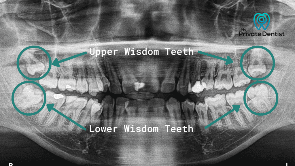 wisdom tooth pain