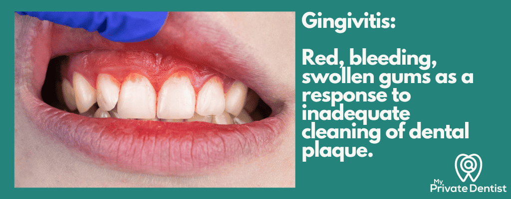 Best toothpaste for gingivitis