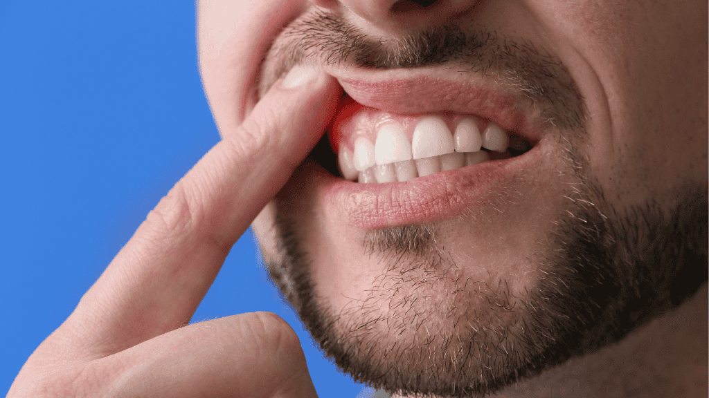 Best Mouthwash for Gingivitis