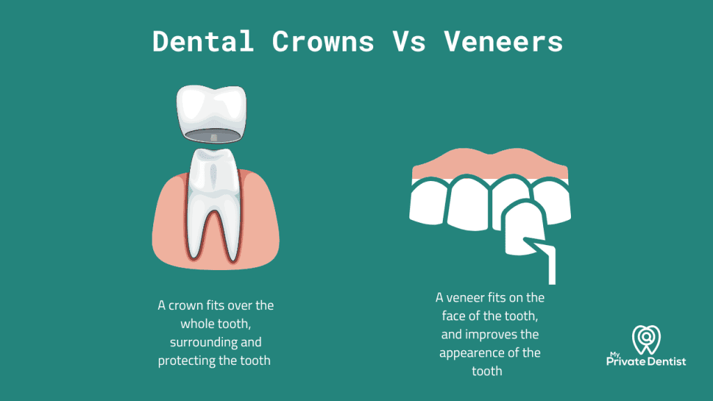 Dental Crowns vs Veneers