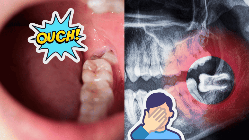 Wisdom tooth pain 