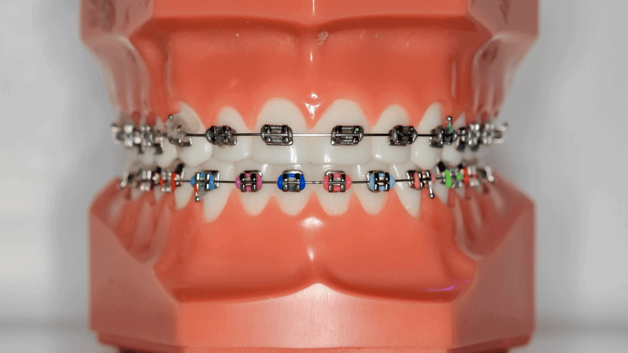 How do metal braces move teeth?