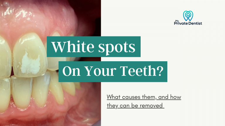White spots on teeth