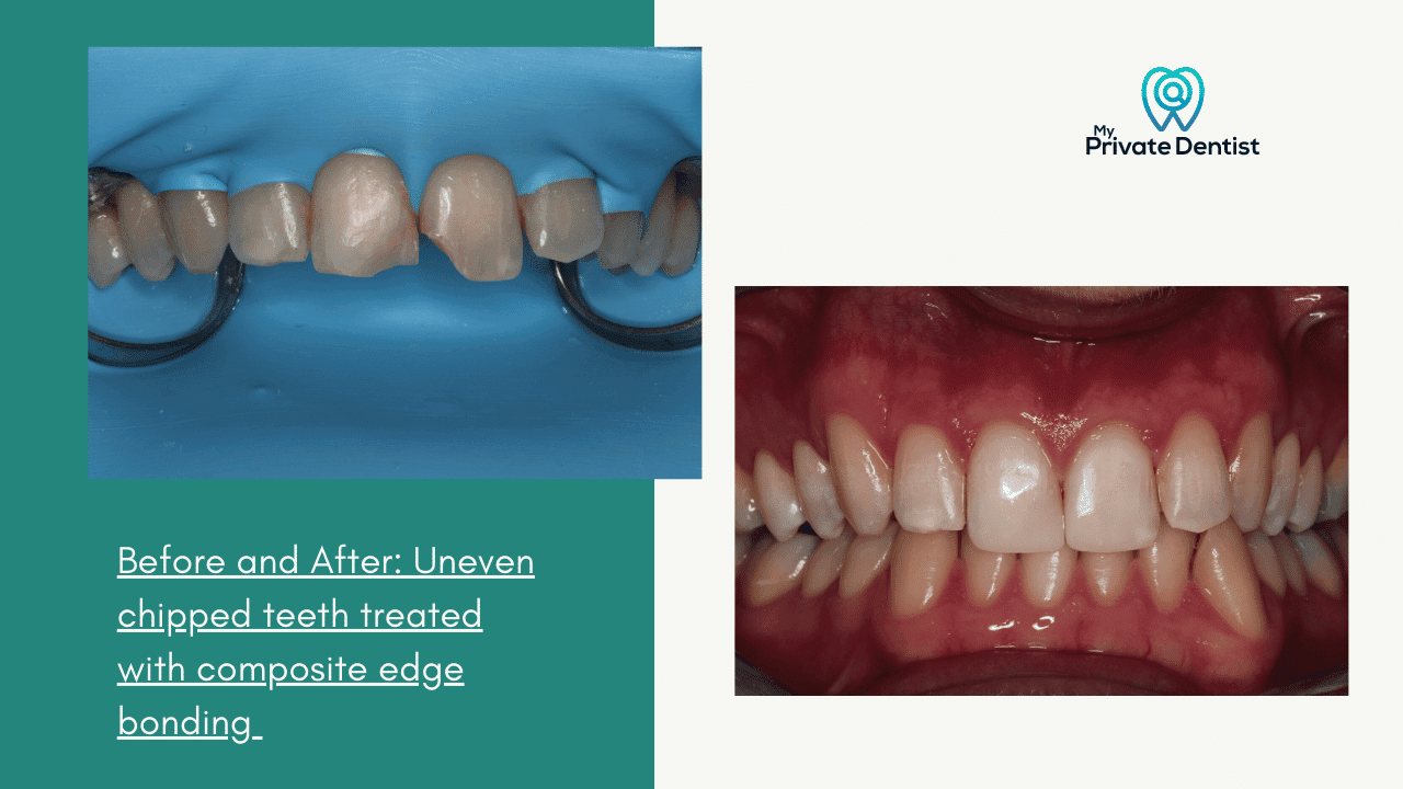Composite Edge Bonding vs Veneers?