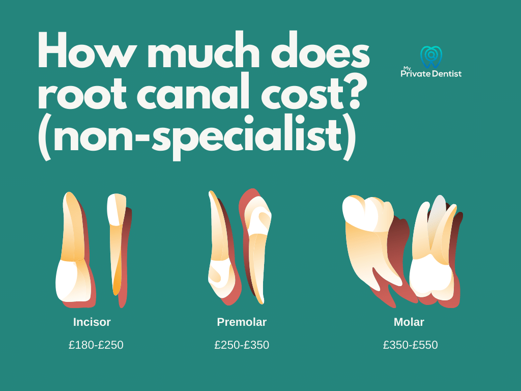 root canal cost