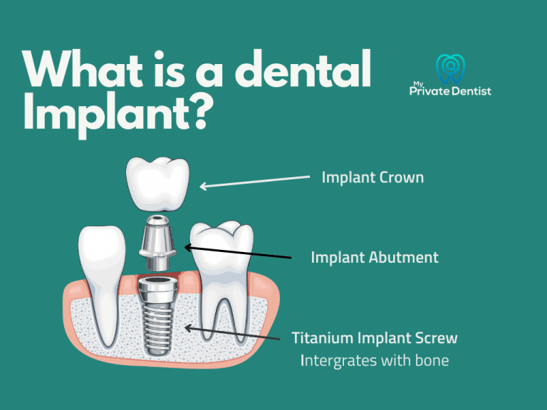 Tooth replacement What is a dental implant?