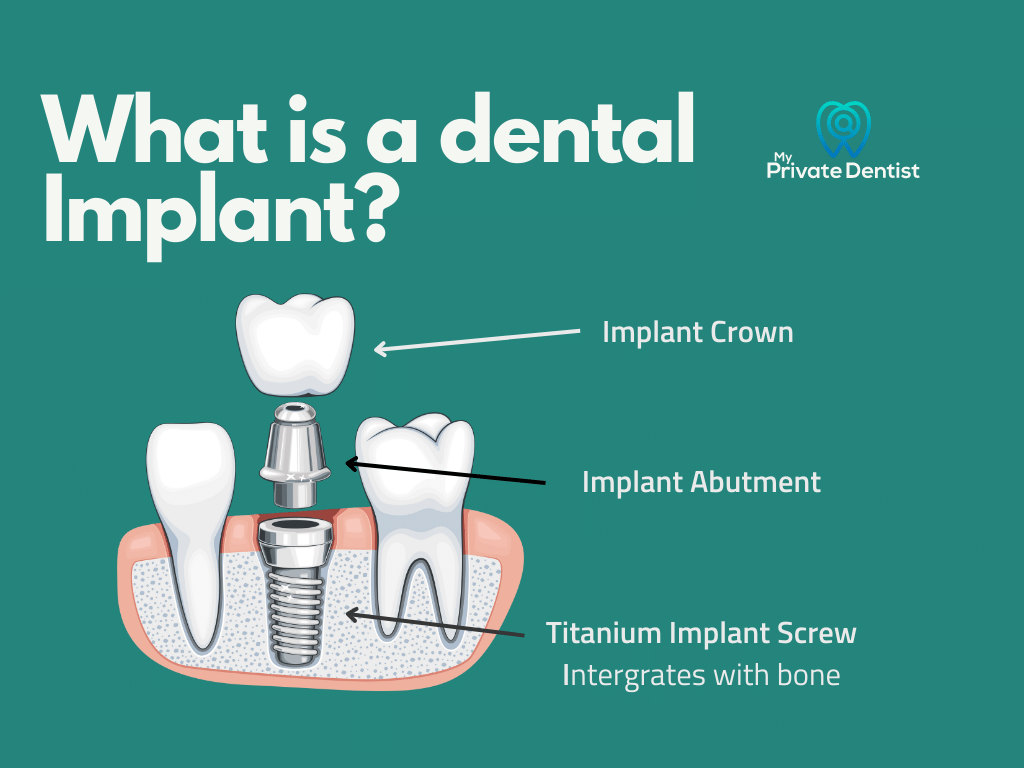 Tooth replacement: What is a dental implant?