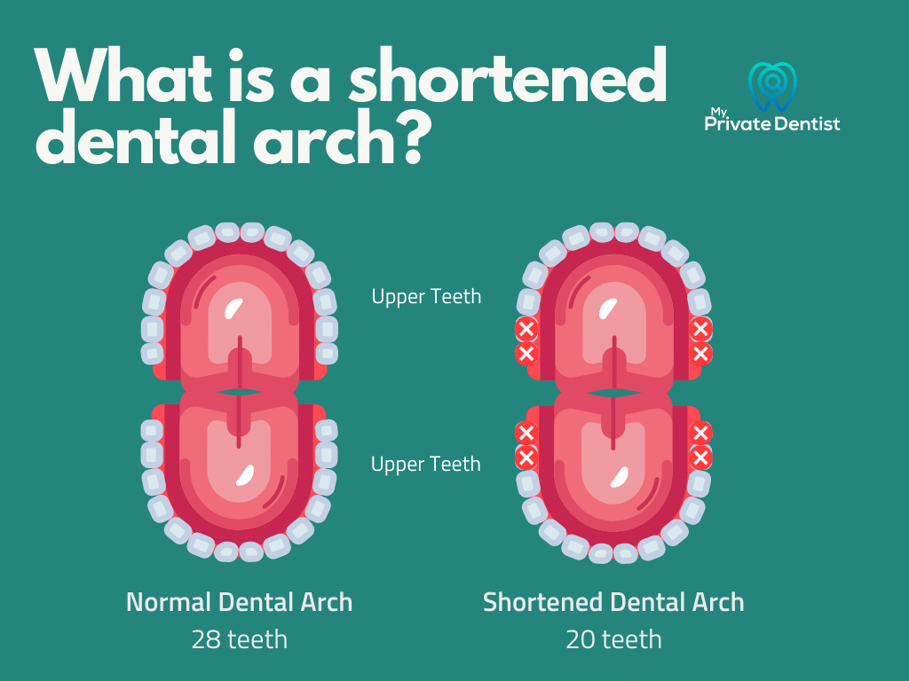 Do I need a tooth replacement?: Shortened Dental Arch