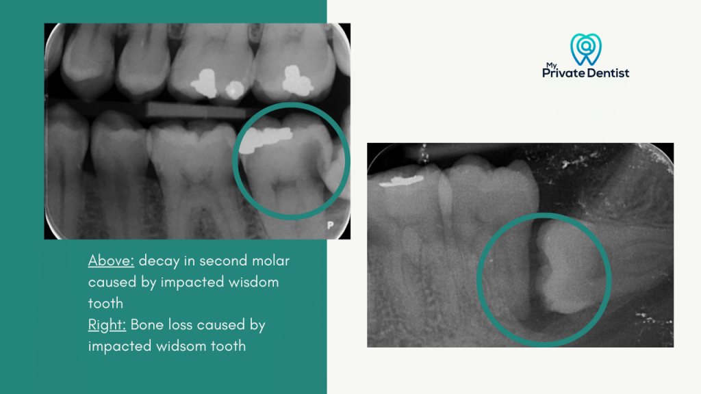 Wisdom tooth pain 