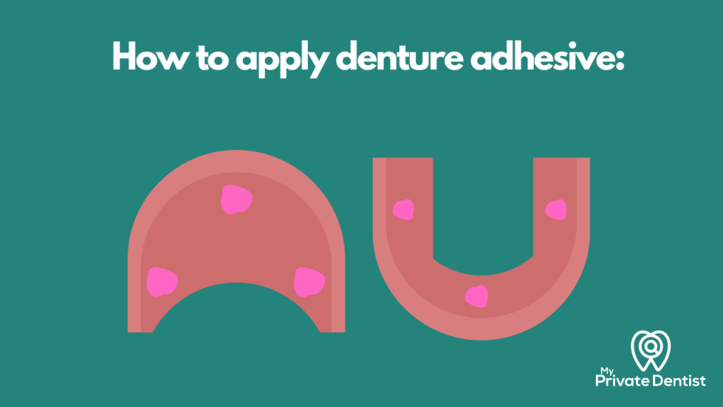 Best Denture Adhesives