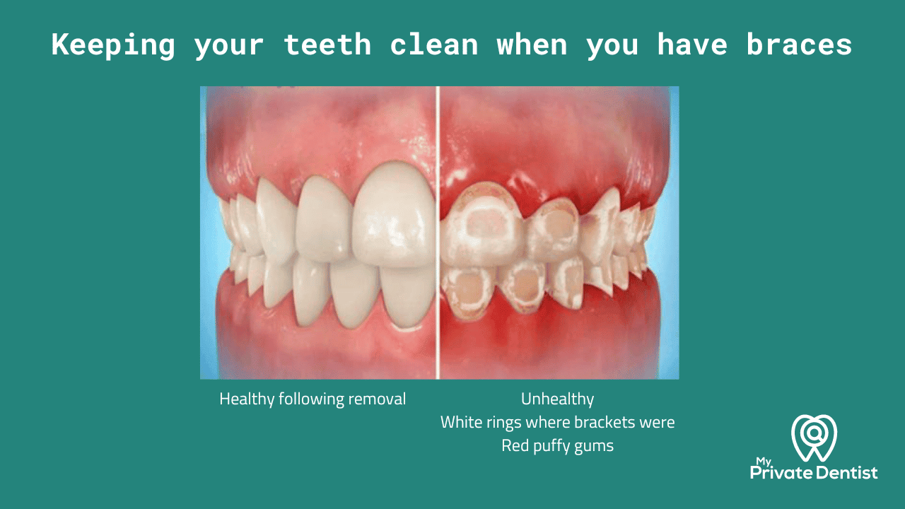 Best dental floss for braces